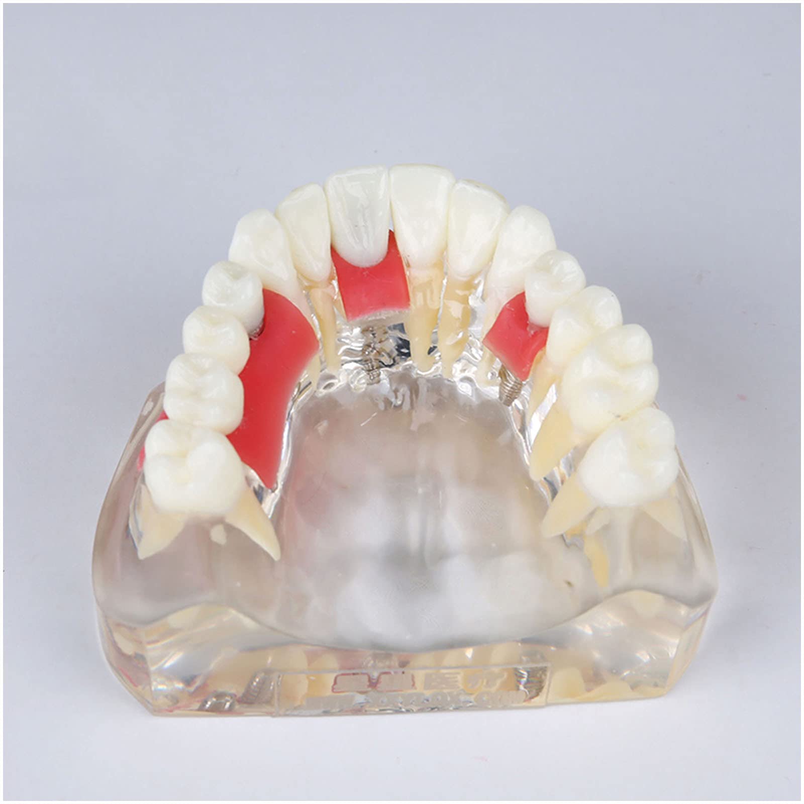 Modèle D'implant De Dents - Modèle De Restauration Supérieure De La Surventure De L'implant Dentaire - Modèle D'étude des Dents Dentaire avec Pilier, Ongle D'implant, Gomme Douce