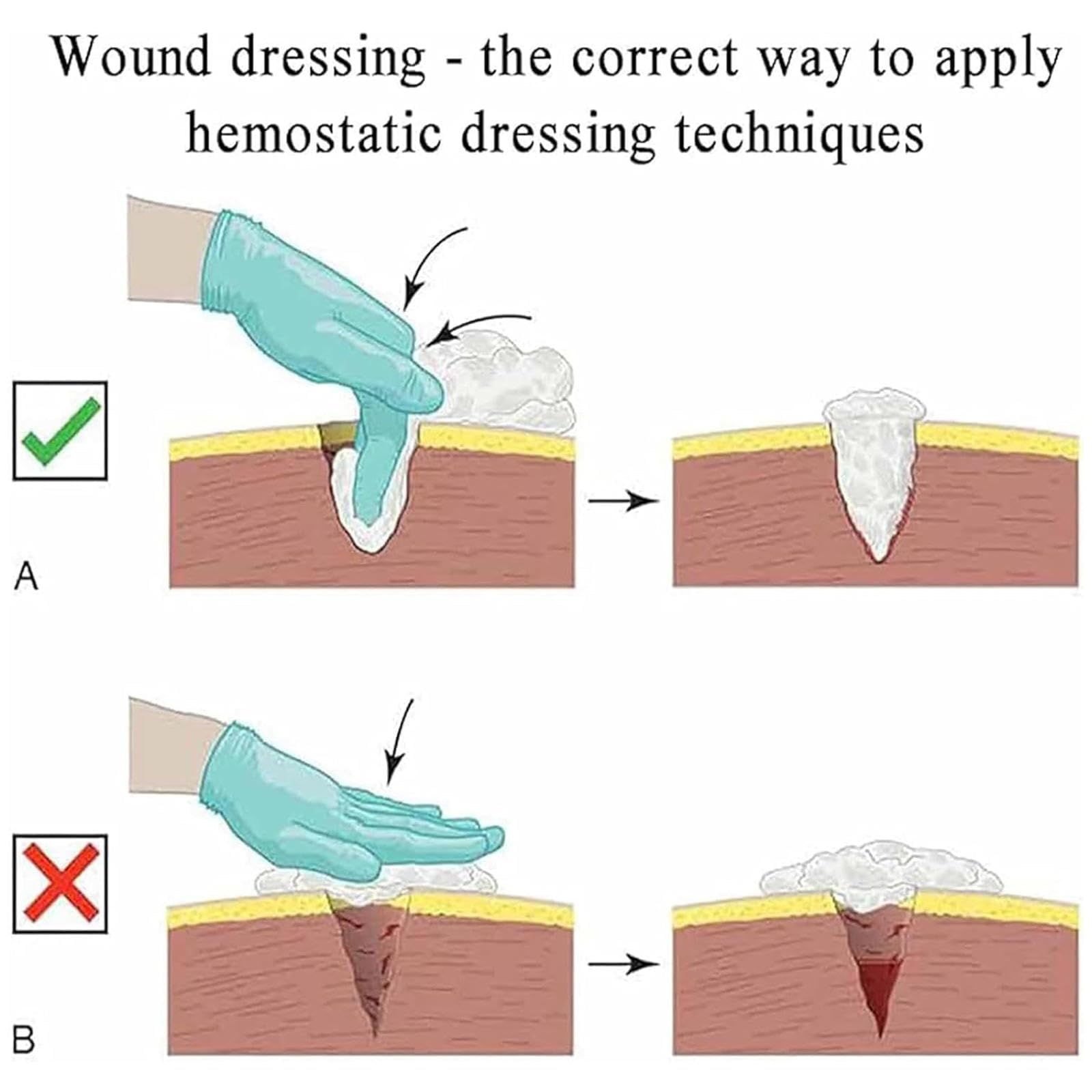 Kit di addestramento per il tamponamento delle ferite alla coscia, esercizi di controllo del sangue, modello didattico riutilizzabile, addestramento di primo soccorso per arrestare l'emorragia, per co