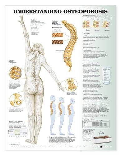 Understanding Osteoporosis Chart