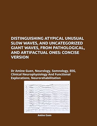 DISTINGUISHING ATYPICAL UNUSUAL SLOW WAVES, AND UNCATEGORIZED GIANT WAVES, FROM