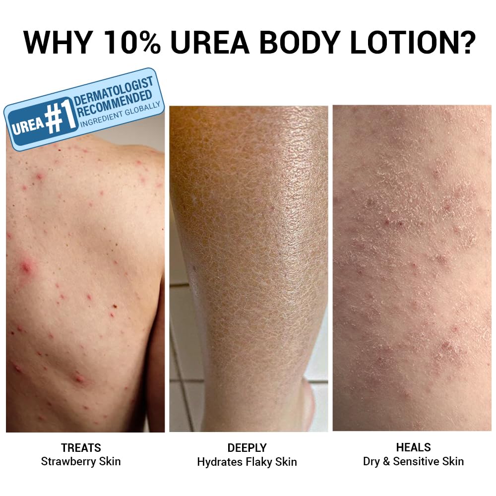 Sereko 10% Urea & Avocado Oil Body Lotion 30ML | For Strawberry legs, Detans, Rough Bumpy skin| Body lotion for Men & Women | AHA BHA free | Gentle Exfoliating | with 48H Moisturization | Very dry, flaky skin 1