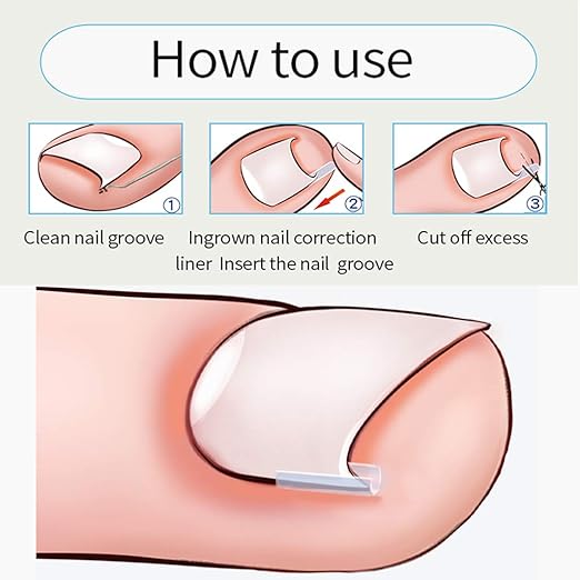 Amazon Com Abbraccia Professional Ingrown Toenail Correction Tools Set Own Tailoring Suitable For Toenails Of Different Sizes Flexible Material Prevent Allergy 24 Liner Beauty Personal Care