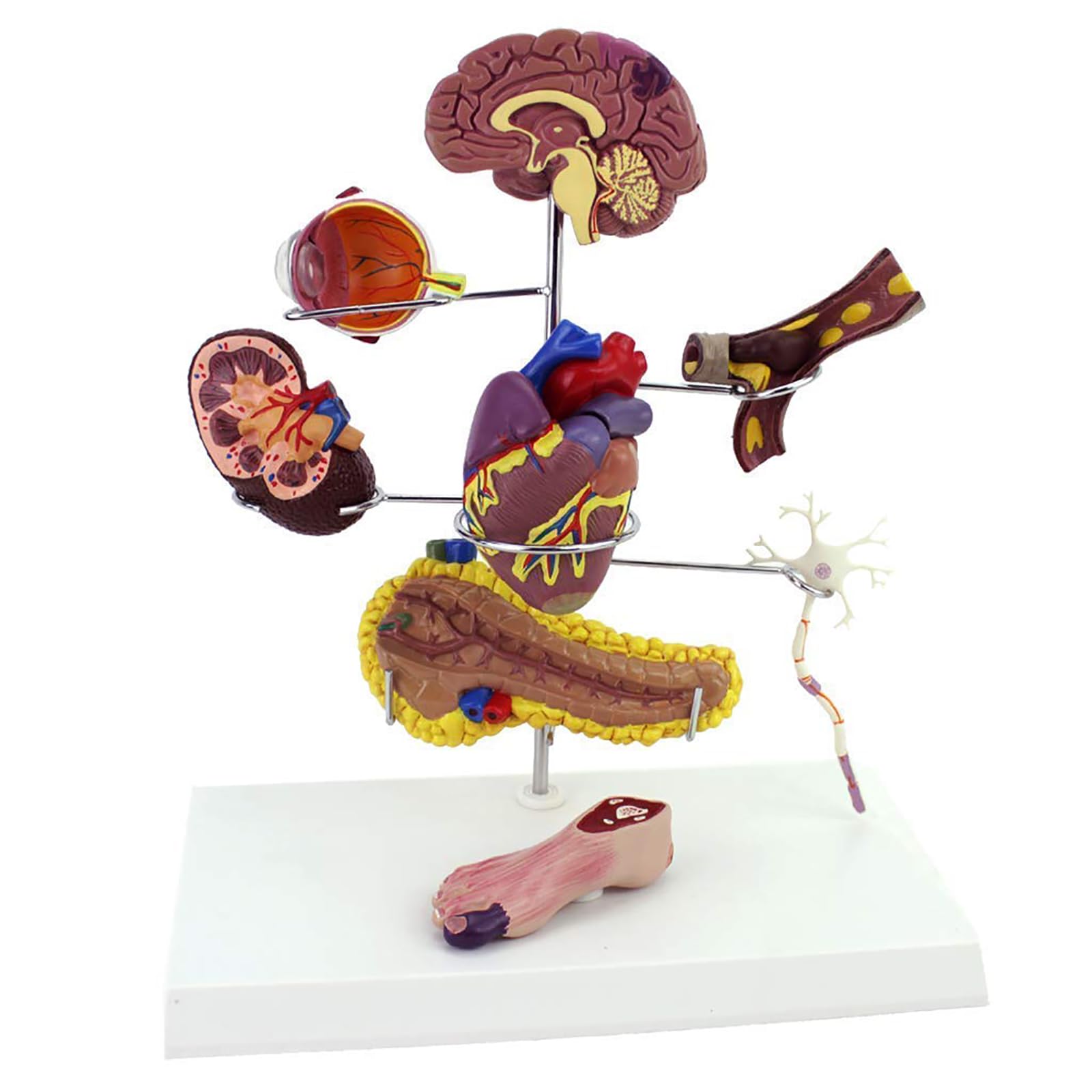 Diabète Pathologique, Modèle D'organe Humain, Modèle Anatomique De Diabète 8 Pezzi, Thrombose Coronarienne Artériosclérose Montrer Utile
