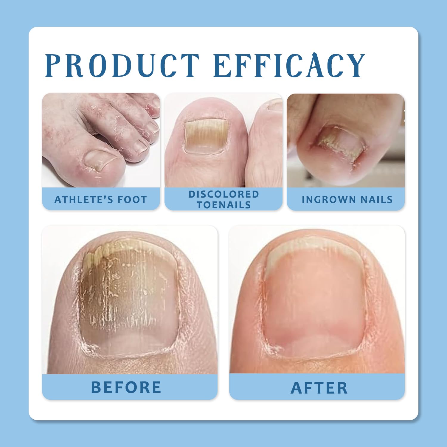 Optimised Nail Protection Patches for Overnight Foot and Toenail Care - Image 4