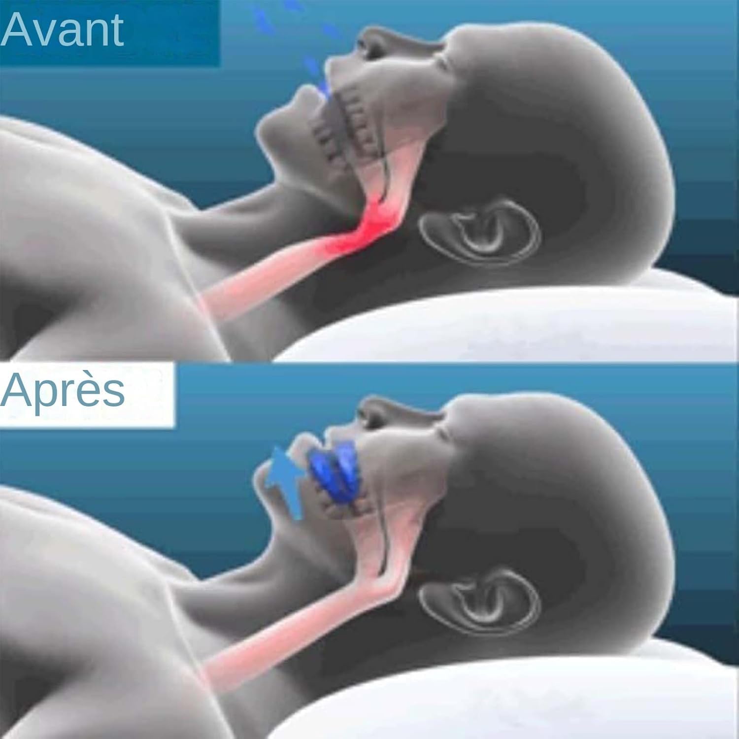 Antironquidos, Ronquidos, Dispositivo Bucal Antirronquidos Reutilizable, Dispositivo De Avance Mandibular Uso Cómodo Y Enérgico