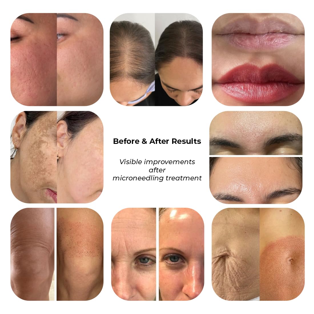 Dr.pen Ultima M8S Microneedling Pen – Kit de Derma Pen Inalámbrico con 20 Cartuchos de Repuesto