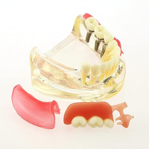 Miniatura 9 de Dientes de implante dental Modelo Typodont Sobredentadura 3 Implantes Puente Inferior Restauración Inferior Tratamiento Demostración Estudio Enseñar