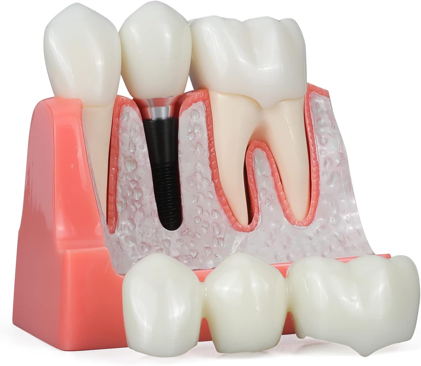 ANNWAN Dental Implant Model 4 Times Removable Analysis Crown Bridge Demonstration Teeth Model for Class Education and Studying Teeth Model
