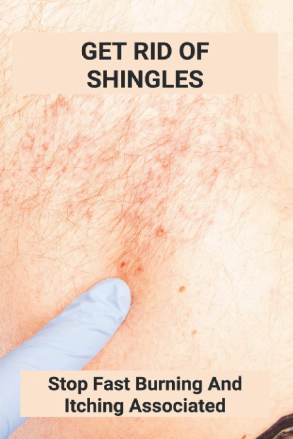 Get Rid Of Shingles: Stop Fast Burning And Itching Associated: Shingles On Face Treatment