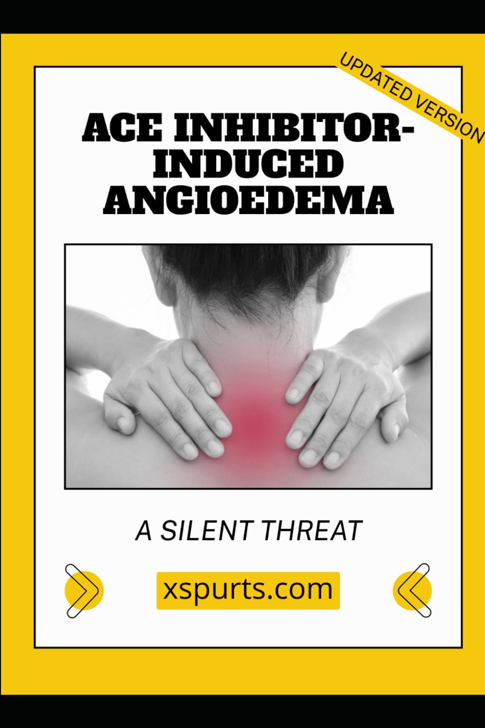 ACE Inhibitor-Induced Angioedema: A Silent Threat