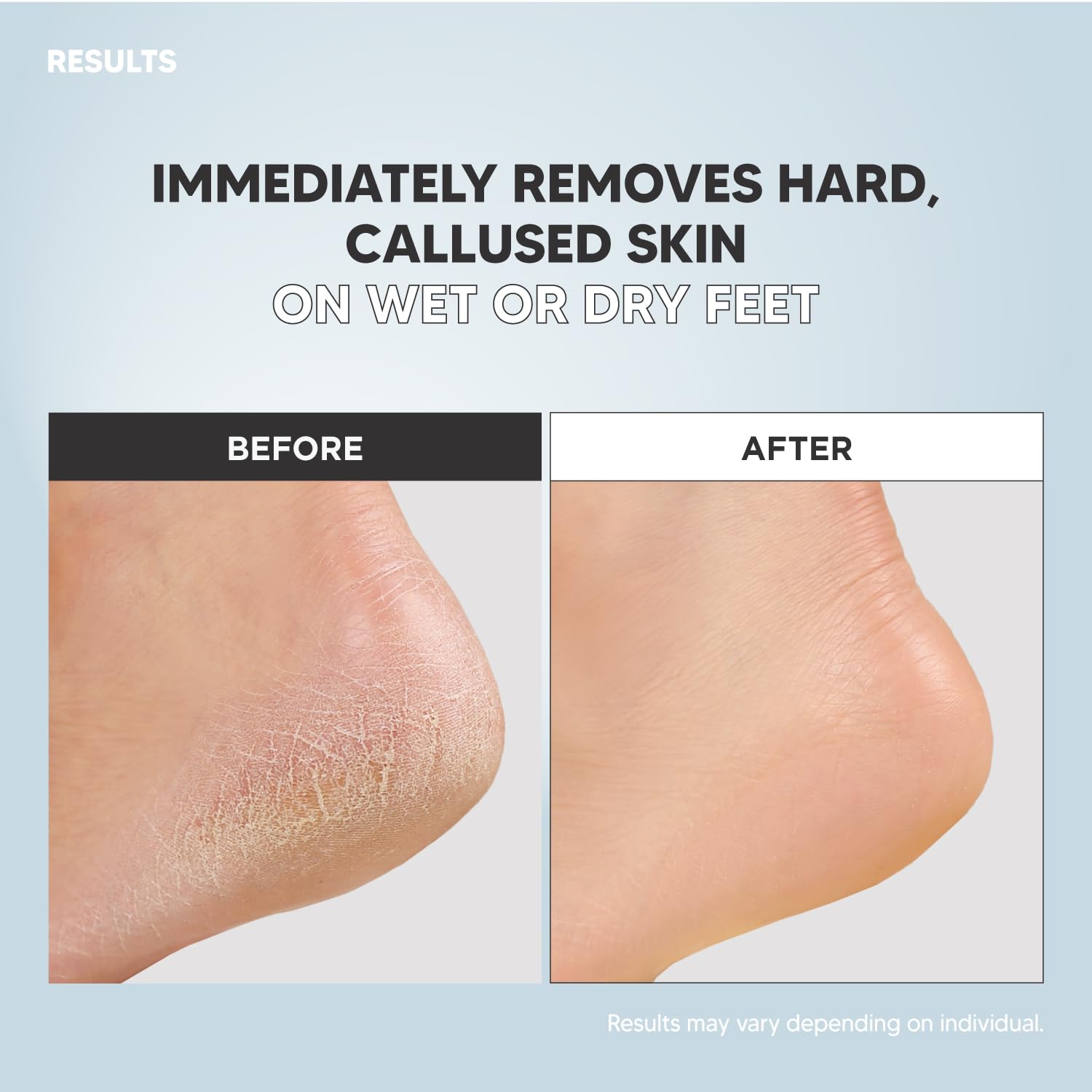S-Line - Set di lime per piedi (bianco) e spray ammorbidente per piedi, strumento per pedicure, efficace per talloni screpolati, cura dei piedi, strumento colossale per pedicure su entrambi