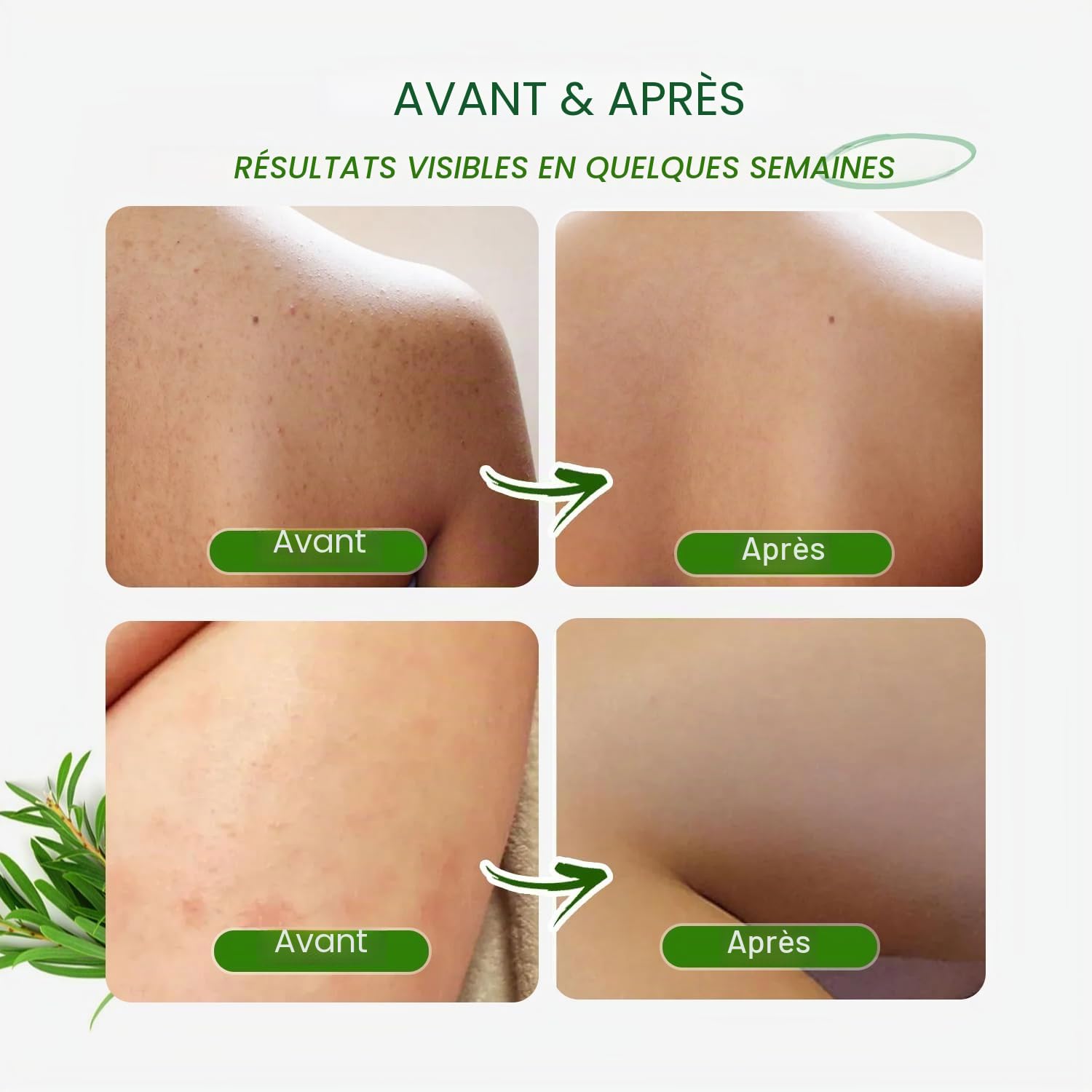 Tea Tree Gel douche antifongique : traitement de la folliculite pour la peau sujette à la dermatite, l'acné du visage et du corps, démangeaisons, pied d'athlète, teigne, tinea versicolor, odeur