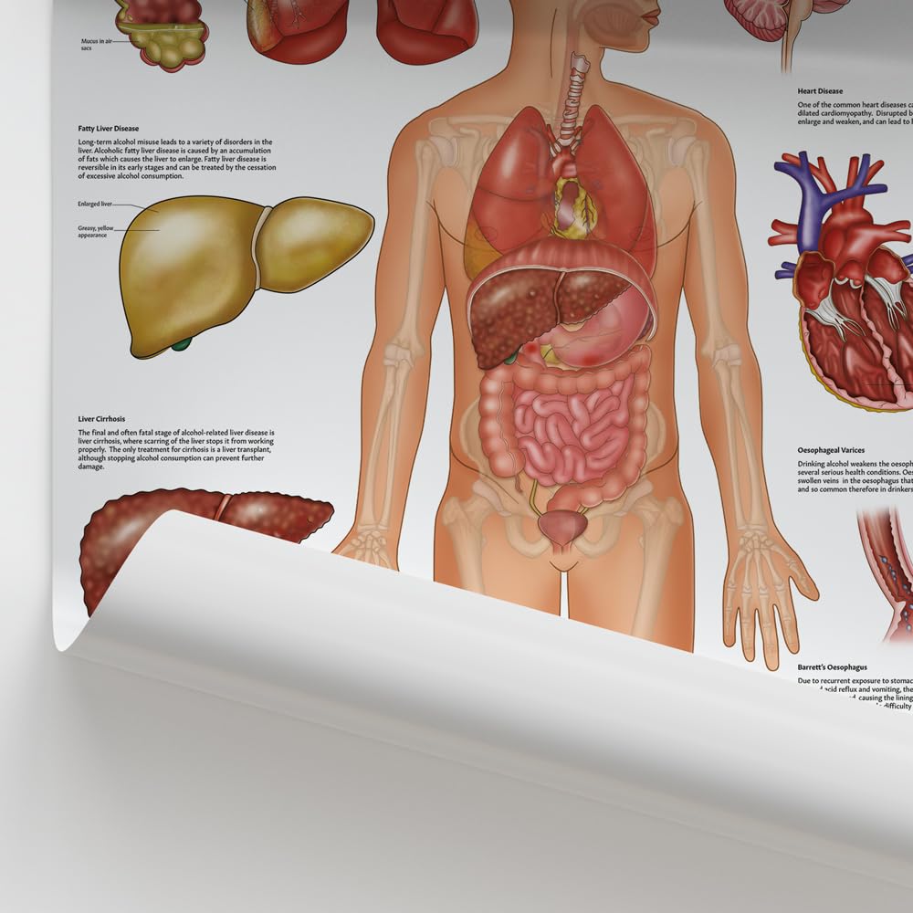 Poster "Alcohol and The Body", 45 x 60 cm, menschliche Anatomie, anatomisches Poster für Bildung, Lernen und Studenten, Alkoholeffekte auf den menschlichen Körper, Pathologie-Poster