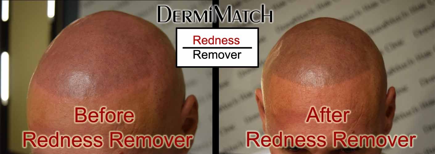 DermiMatch Redness Remover