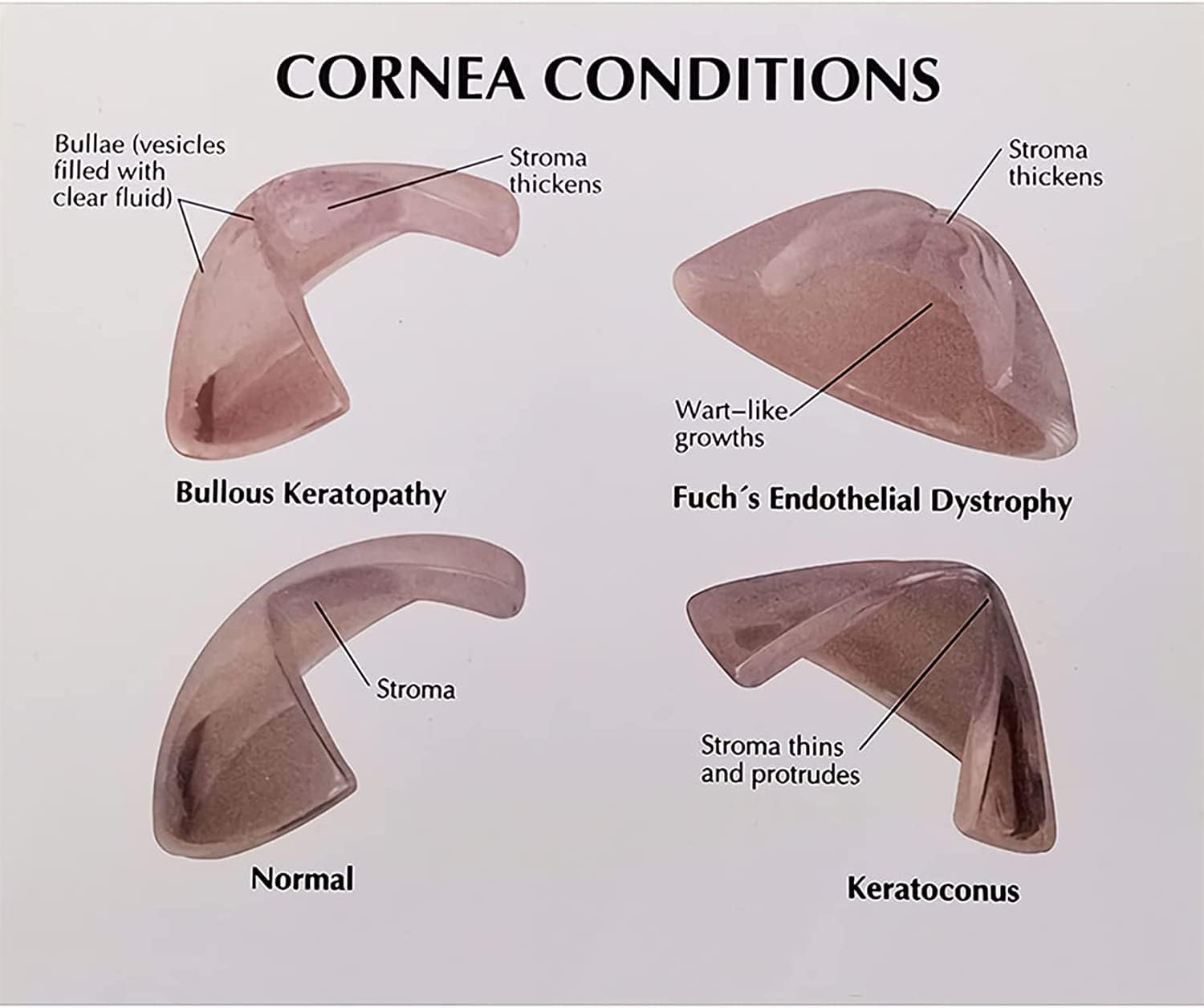 教育モデルツール、眼病変モデル、取り外し可能な白内障眼モデル、半眼解剖モデル、角膜モデル、人体解剖学、白内障状態の眼のレプリカ  白内障や糖尿病網膜症など様々な眼疾患の説明に適した眼球模型│F17