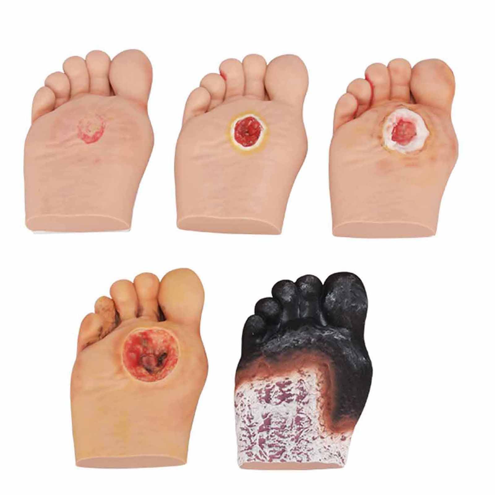 YRQMGSF Diabetic Foot Model 5 Pcs Purulent Wound Foot Model for Medical Study & Science Classroom,Flesh,13cm