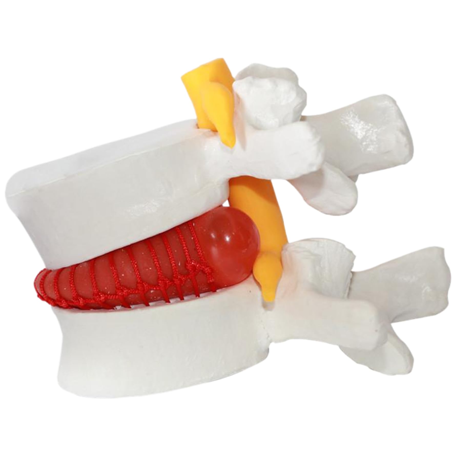 Material didáctico para aliviar la hernia de disco, modelo de cuerpo humano de PVC de vértebra lumbar herniada, modelo de columna lumbar de tamaño natural 1, 5 veces para enseñar, aprender y demo