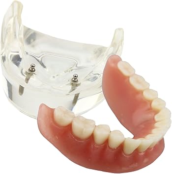 Dental Model Overdenture Inferior 2 Implants Demo for Studing and Teaching