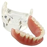 Smile1000 Dental Model Overdenture Inferior 2 Implants Demo for Studing and Teaching