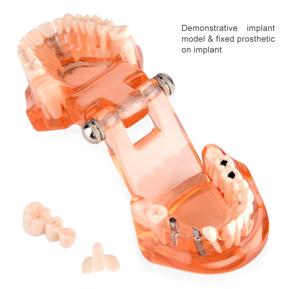 Zahnmodell Gebiss Modell zum Unterrichten Zahndegeneration Demonstrationsstudie Orange Modell Zahnersatz Studium Zahnverfall Lehrmodell Dentalmodell für Studenten und Lehrkräfte