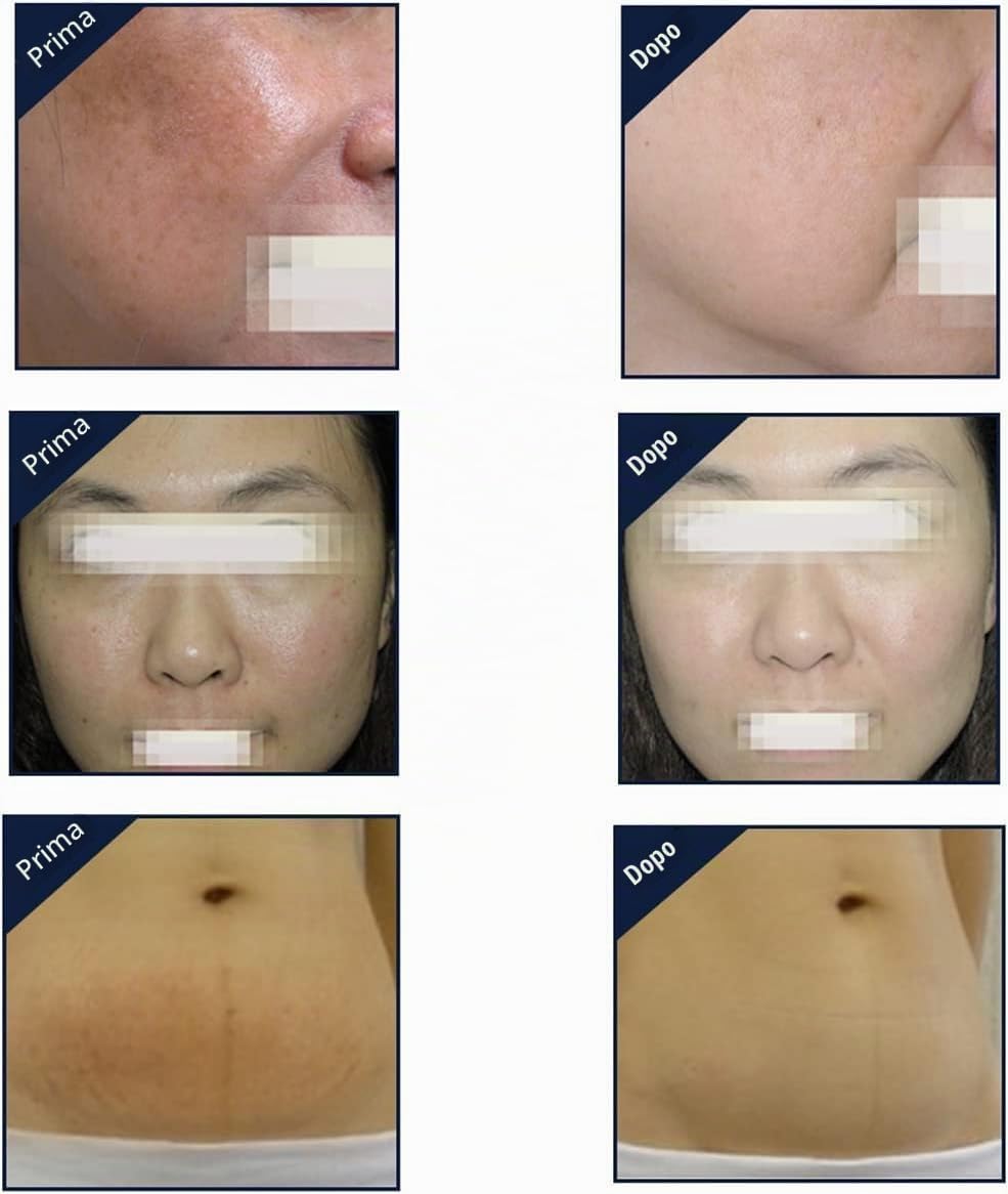RF Radio Frequency Dispositivo Viso e Corpo Strumento per Rassodare la Pelle,strumento di bellezza portatile, utilizzato per ringiovanimento della pelle, antirughe, anti-invecchiamento