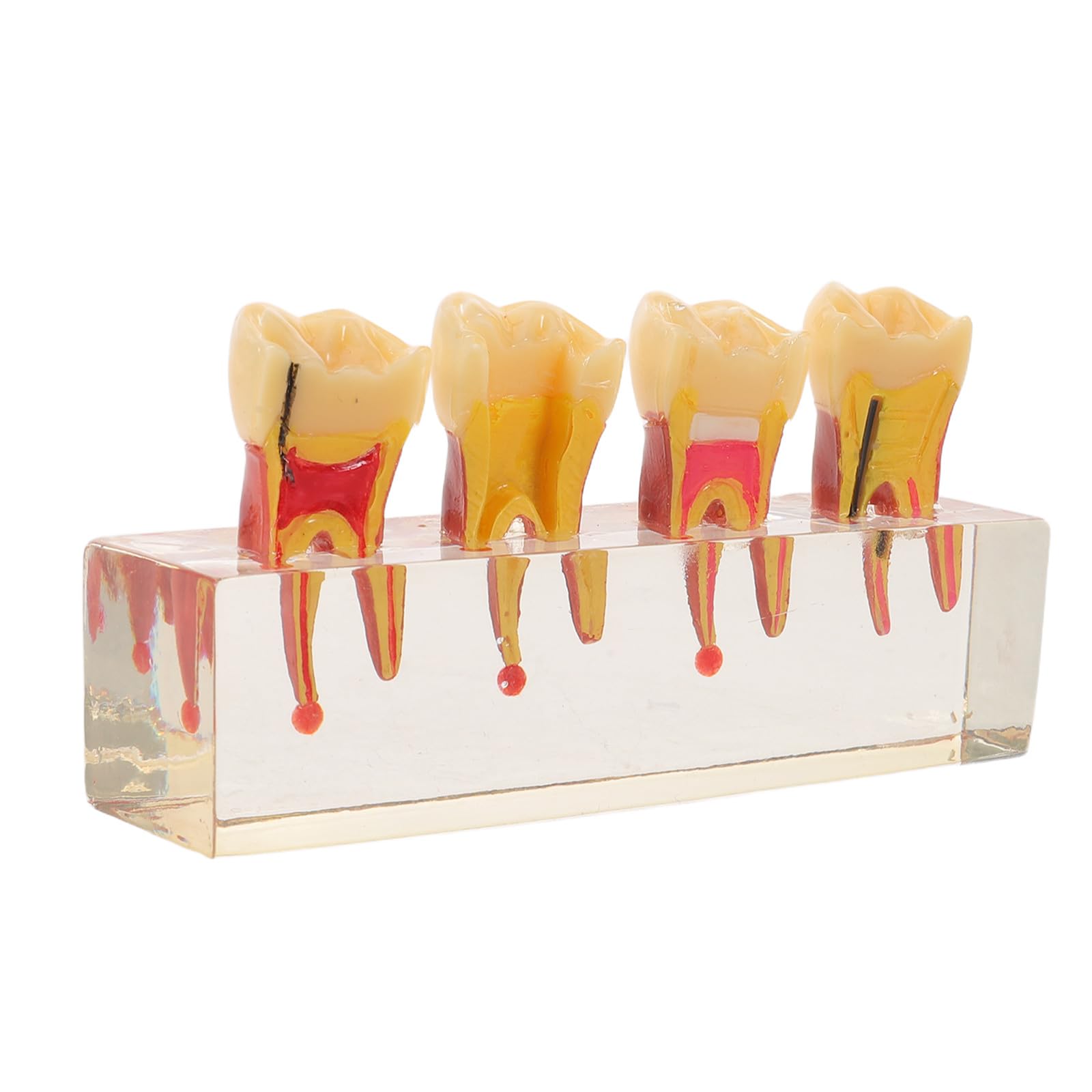 ibasenice Modello di denti pediatrici per la formazione didattica | Rappresentazione realistica dell'anatomia della bocca per studenti di odontoiatria e dentisti | Modello di carie per