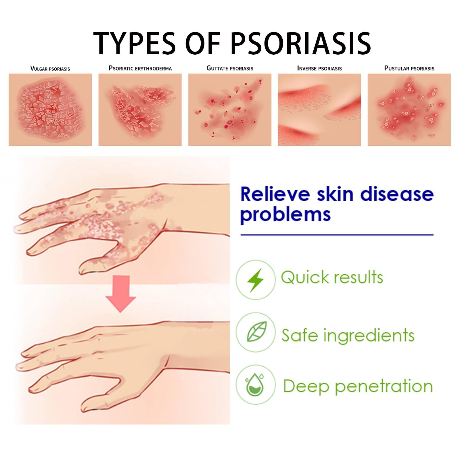 Crèmes Contre Le Psoriasis, Crème à Base De Plantes, Pour le Corps, creme intense, Apaise les Cutanées, Soulagement efficace des démangeaisons Le Pour Réduit Des Démangeaisons