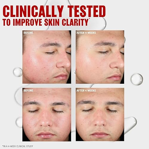 Vista 5 de Thayers Blemish Clearing - Tónico de ácido salicílico, tóner facial para tratamiento del acné con ácido salicílico al 2%, cuidado de la piel