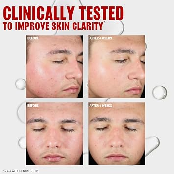 Thayers Blemish Clearing Salicylic Acid Toner, Acne Treatment Face Toner with 2% Salicylic Acid, Soothing and Non-Stripping Skin Care, 12 Fl Oz
