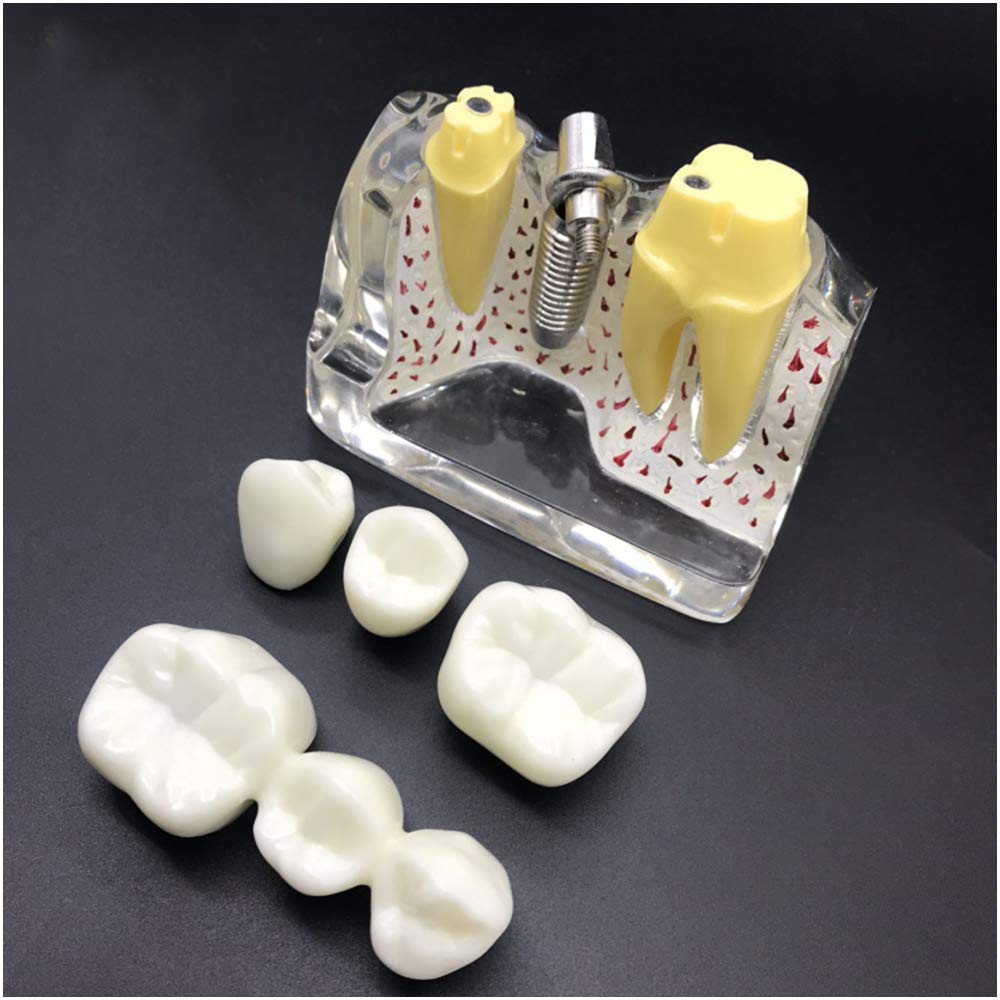 Sjdopulse A Teeth Teaching Model - 4 Times Enlarged Teeth Planting Explanation Model - Simulation Oral Tooth Teeth Demonstration Model - Implant Nail Detachable Crown - For Doctor-Patient Communication ( )