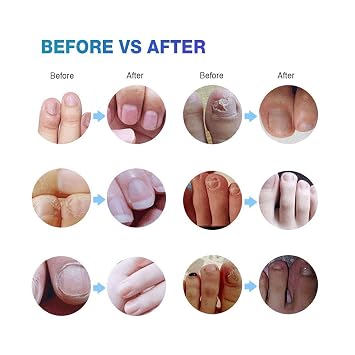 Toenail Fungus Treatment Extra Strength: Nail Fungus Treatment for Toenail - Fungal Nail Repair Pen 4 Packs