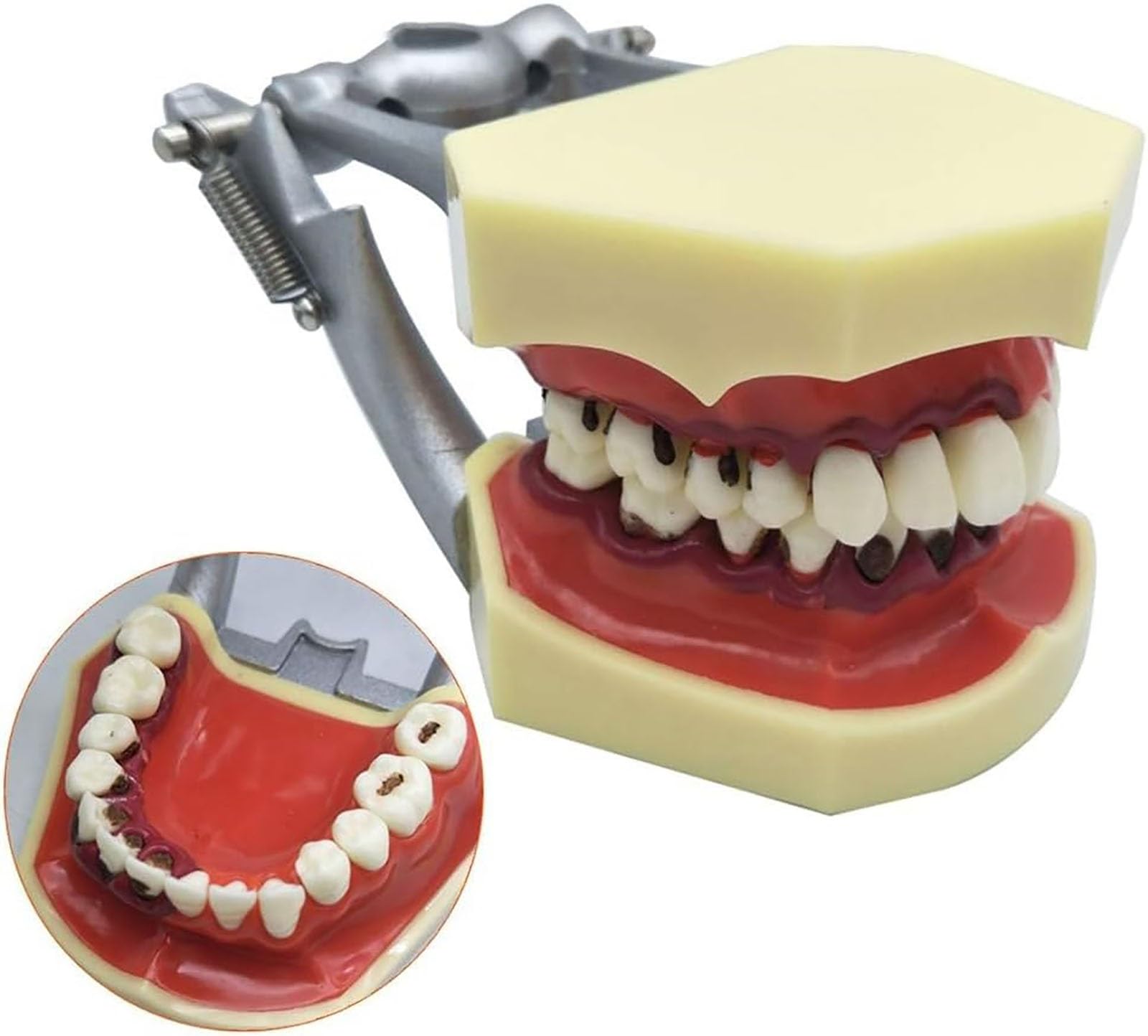 Parodontalpathologisches Zahnmodell mit abnehmbarer Gingiva, Demonstrationsmodell for die zahnmedizinische Patientenaufklärung for Zahnärzte und mündliche Unterrichtskommunikation