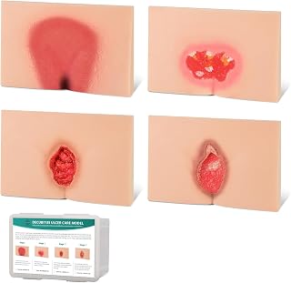 Decubitus Ulcer Wound Care Model, Bedsores Model, Pressure Injury Model for Medical Training Practice, 4 Stages