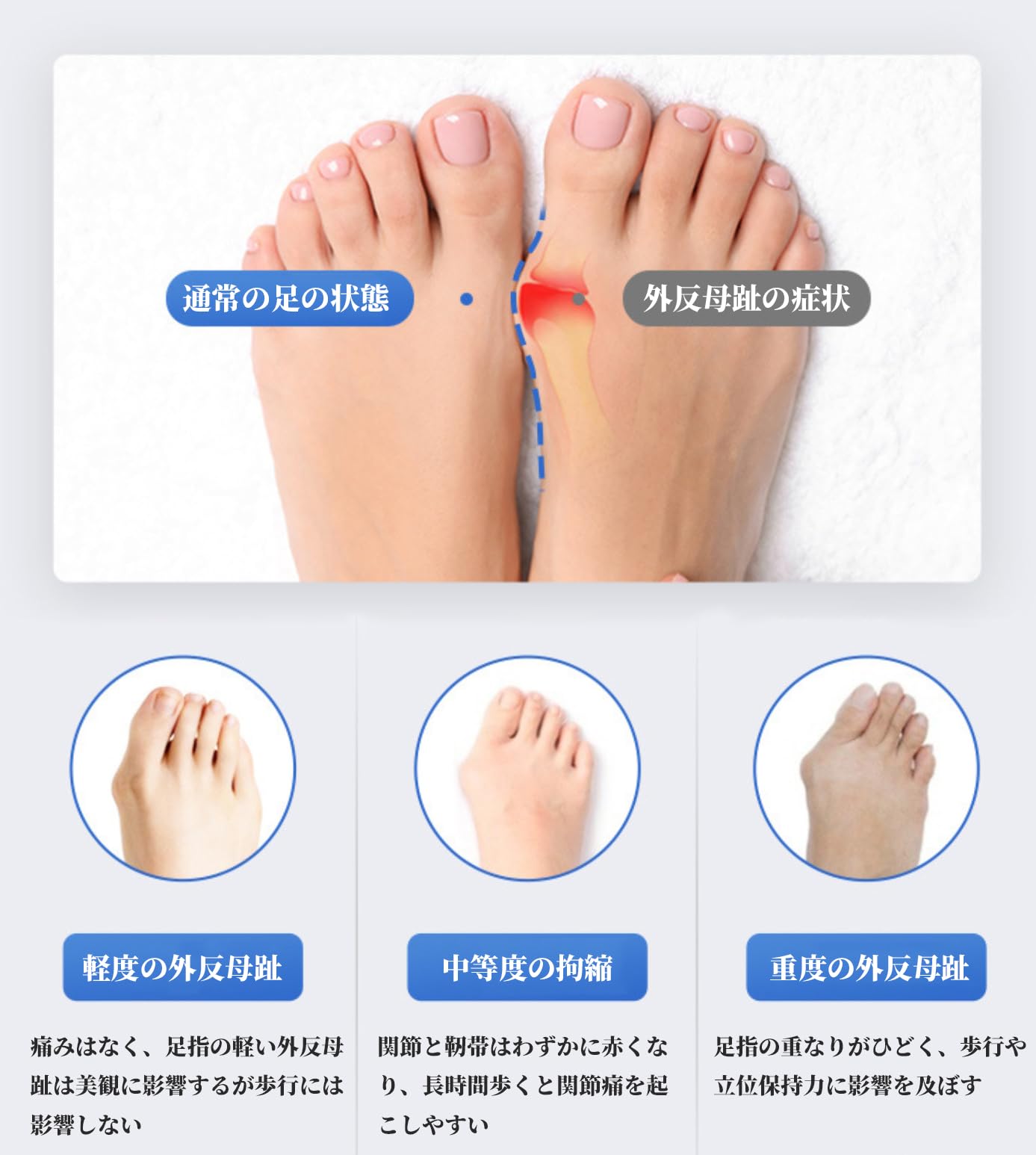 Amazon | FTBOL 外反母趾 サポーター 寝る時 足指 広げる 寝る時