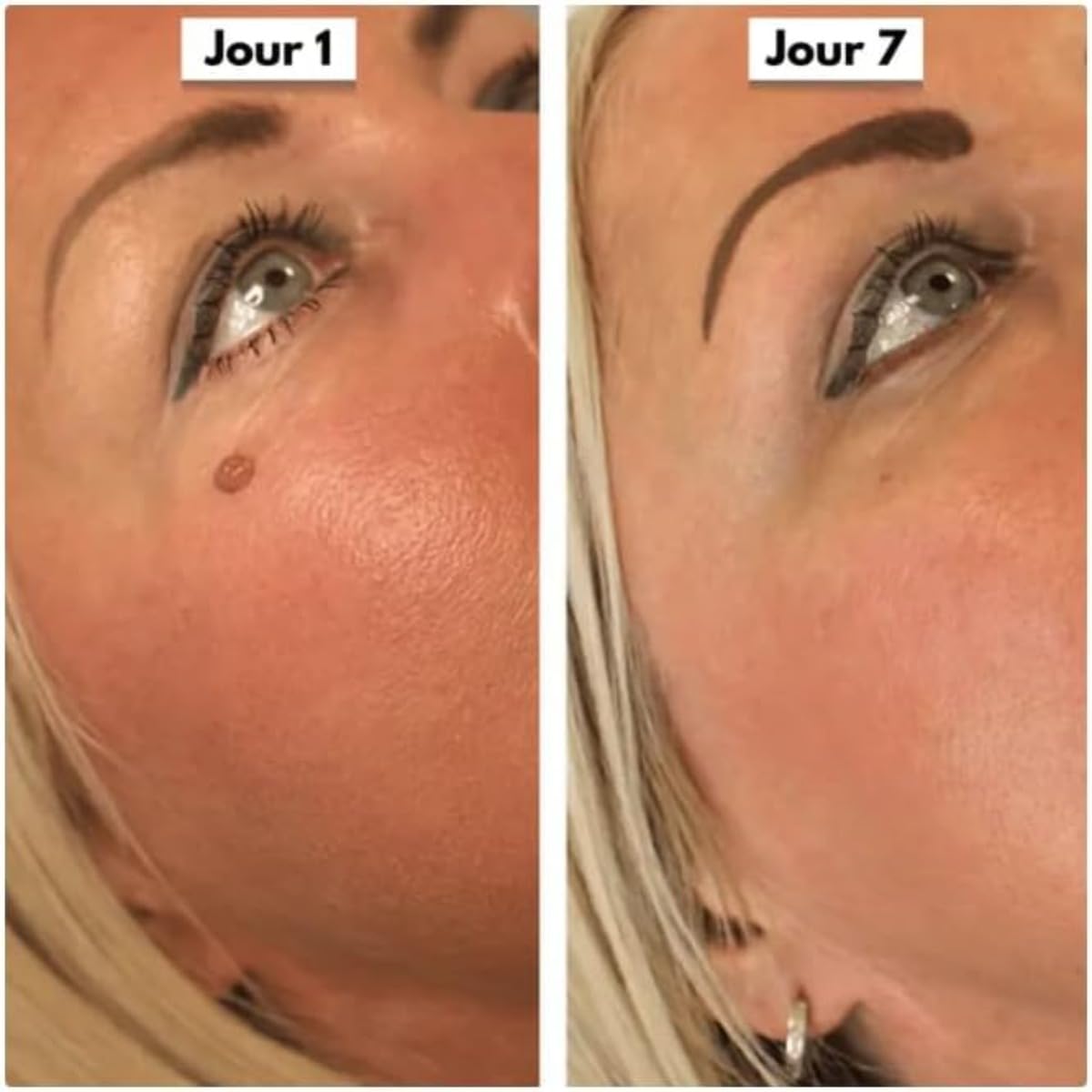 DermaSkin Pro - Adieu Les Acrochordons Améliore La Douceur De La Peau Indolore Et Facile À Enlever Pour Femme (Bleu 1 ensemble)
