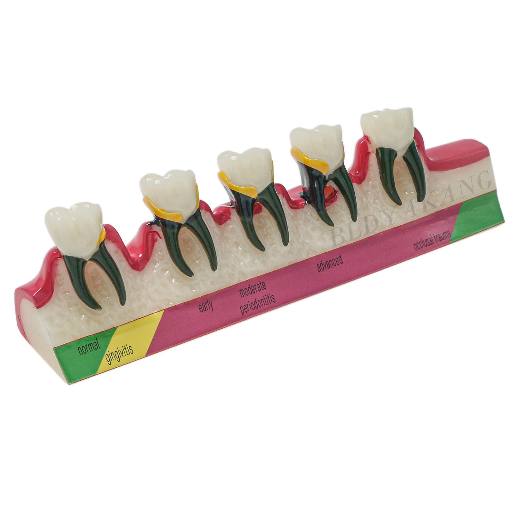 Dental Periodontal Disease Teeth Model Doctor-Patient and Oral Care Education Model Showing Gingivitis ~ Advanced Periodontitis 5 Stages