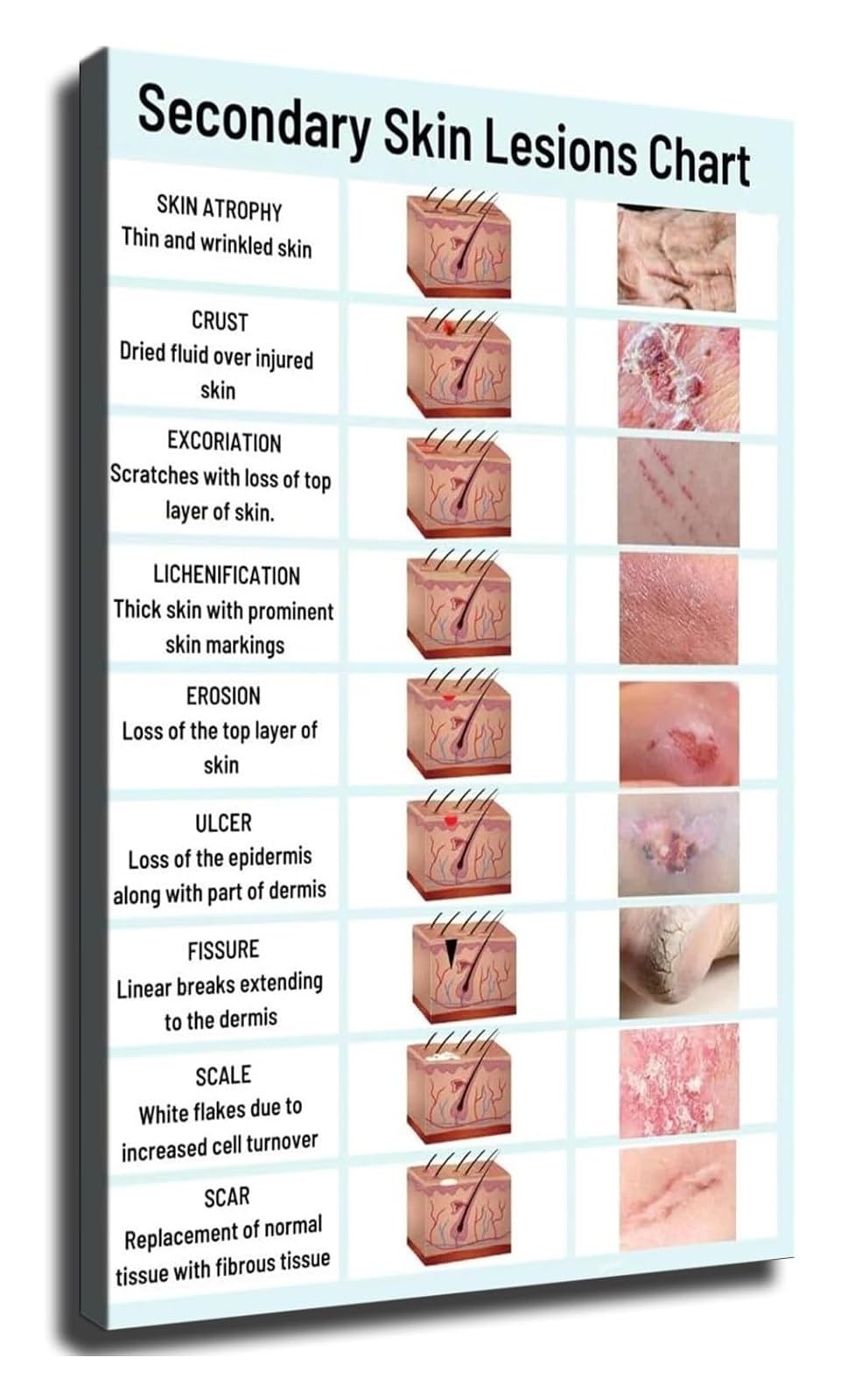MQXFCZUX Skin Anatomy Poster Dermatology Chart Secondary Skin Lesions and Skin Layers Educational Wall-Art for Doctor Office and School Framed,08x12inch(20x30cm)