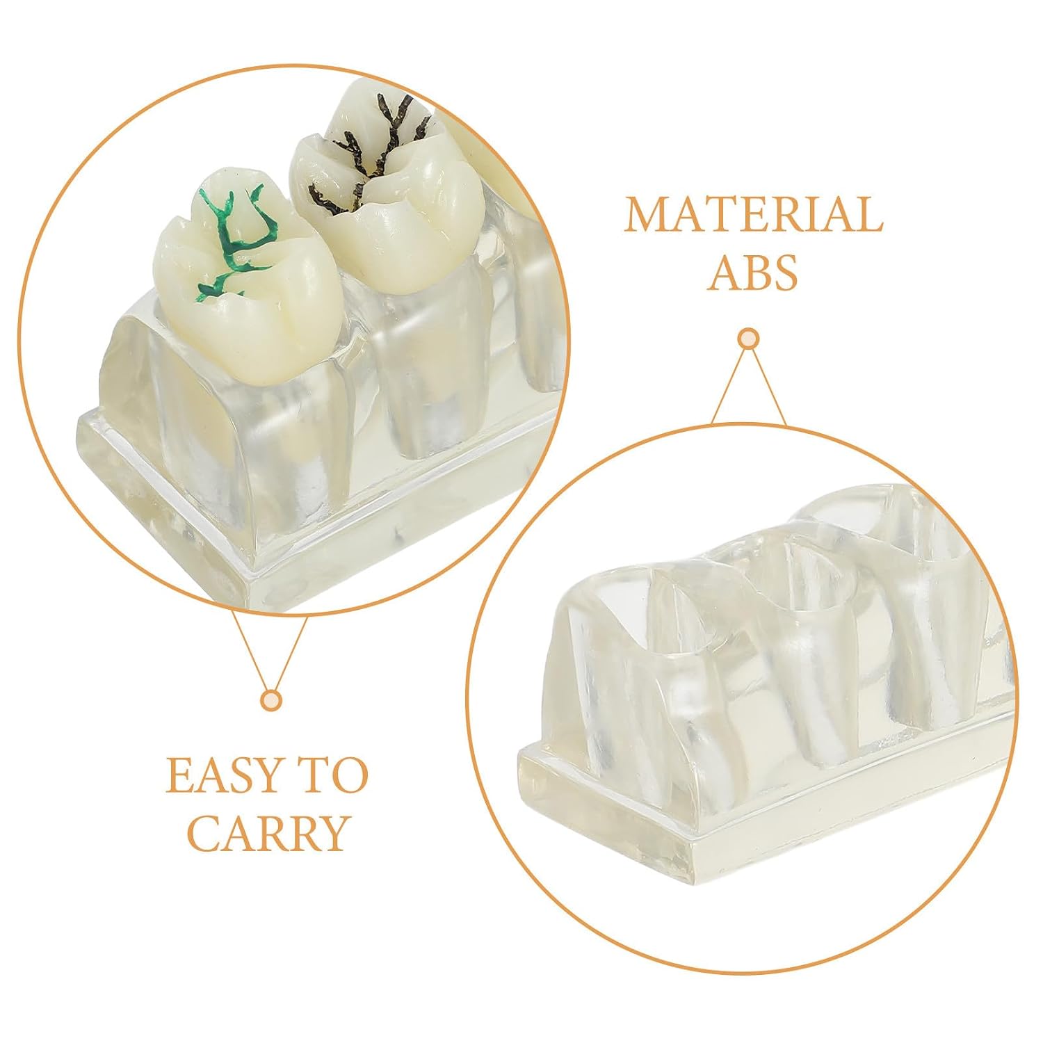 Caries Teeth Model - 4 Times Oral Anatomy Education Tooth Model for Students and Hygiene Learning Materials - Caries Indentification Tool