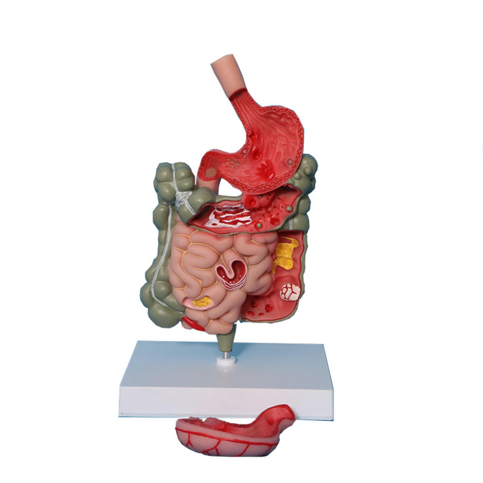 SORECI Human Stomach Anatomy Model Pathological Digestive System Model, Removerable Teaching Model,Stomach Section Large Small Intestine Medical Model Anatomy