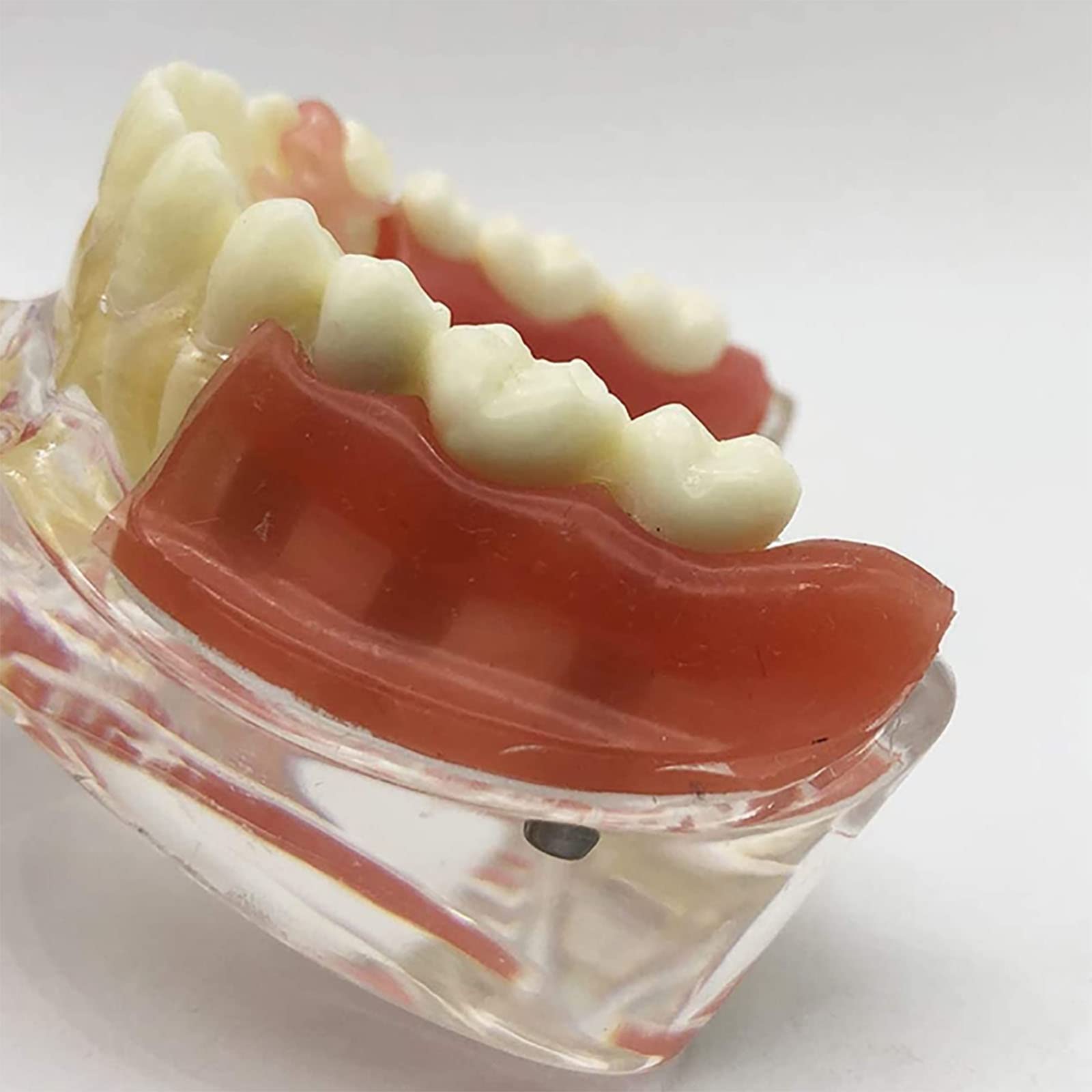 PEAMAN Modello di Cure odontoiatriche, Modello di impianto Dentale e restauro dei Denti a confronto con gengiva e Protesi Rimovibile per Lo Studio e la dimostrazione didattica