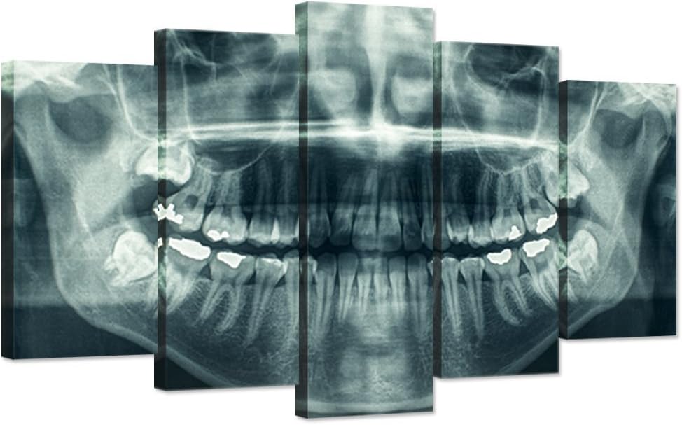 Modern 5 Panel Canvas Wall Art X-Ray Dental Tooth Oral Panoramic The Picture Teeth Decay Print for Dental Room Stretched And Framed For Living Room Ready To Hang
