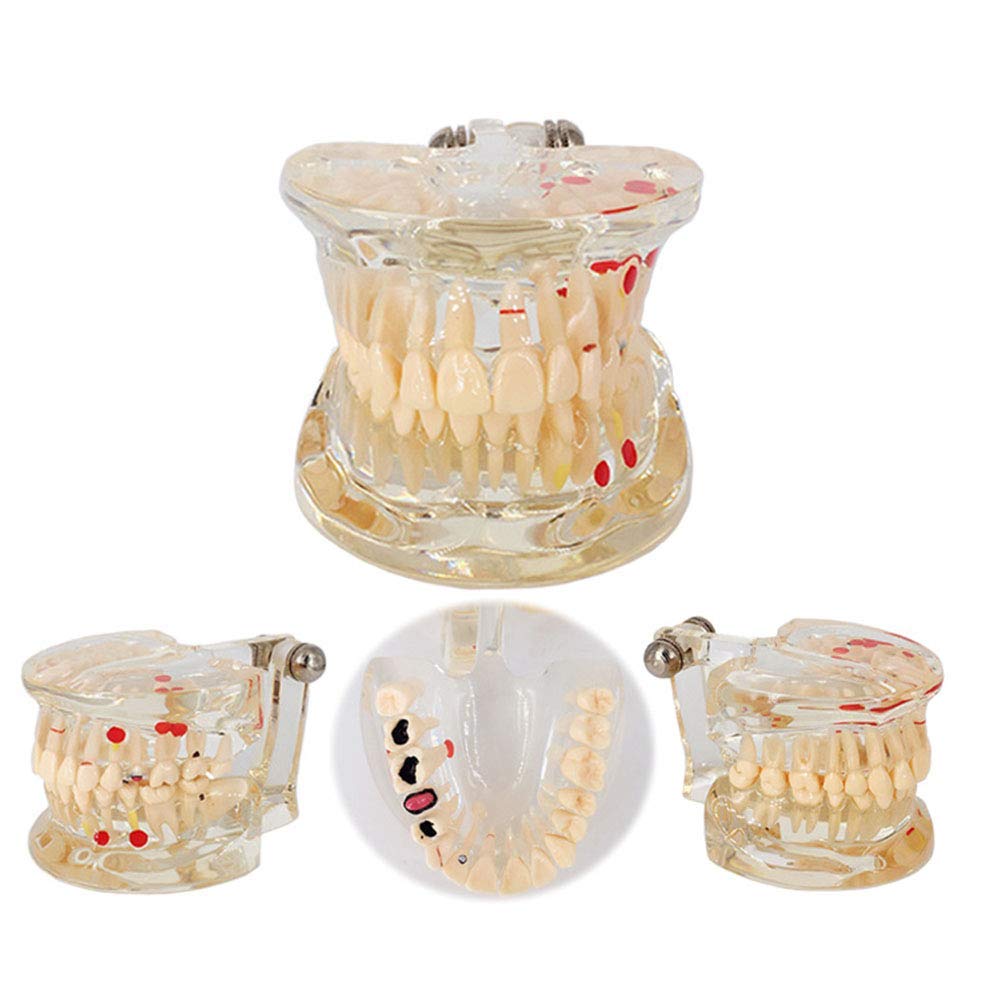 Sjdopulse Pathological Tooth Model, Dental Teaching Model, Some Teeth Are Removable, Suitable For Dental Learning