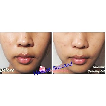 Acniclear Cleansing Gel 120 Ml.(Honest Succeed)