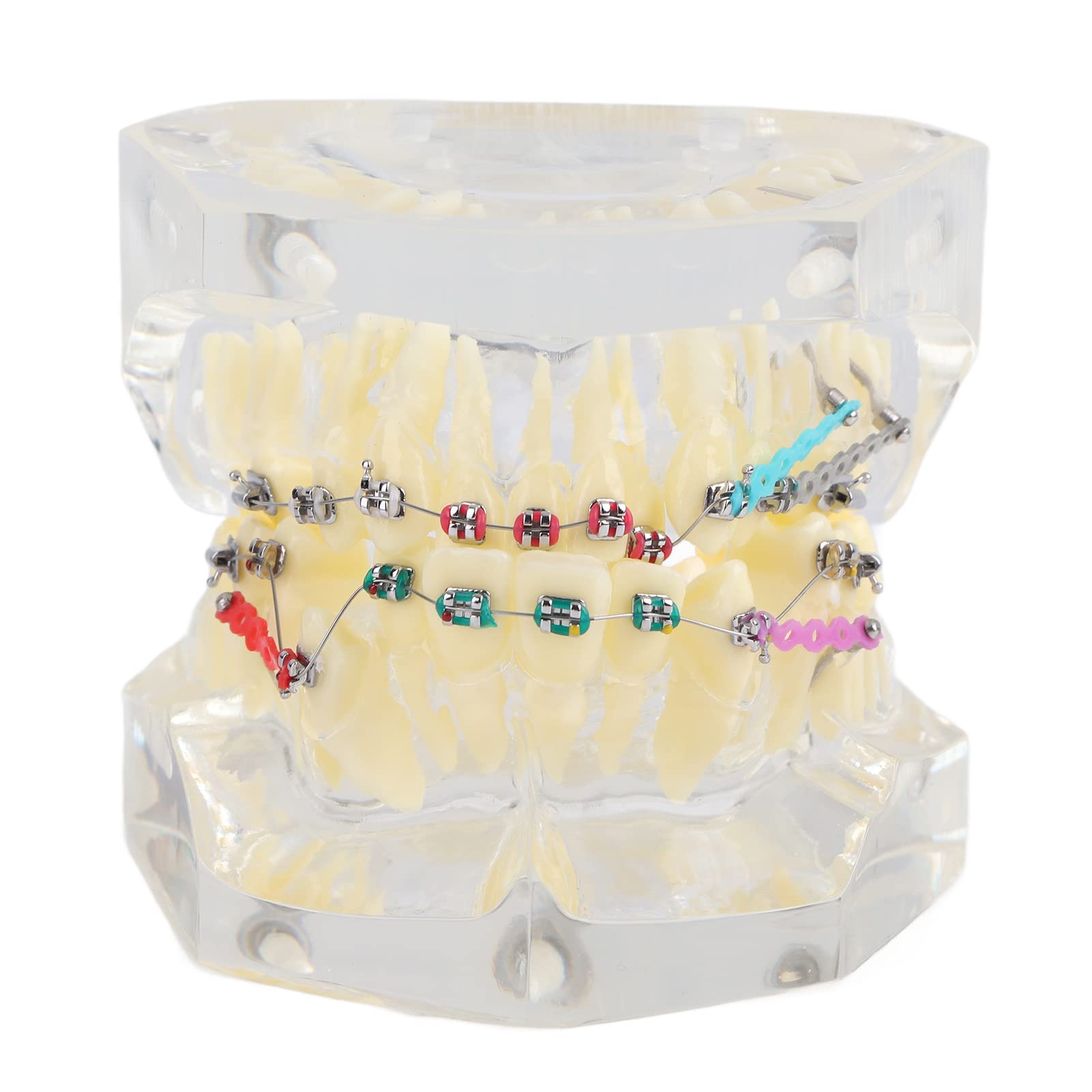 Staffe Ortodontiche, Modello di Denti Trattamento Ortodontico Dentale Studio di Malocclusione Modello di Denti con Staffe Dentali a Catena Metallica