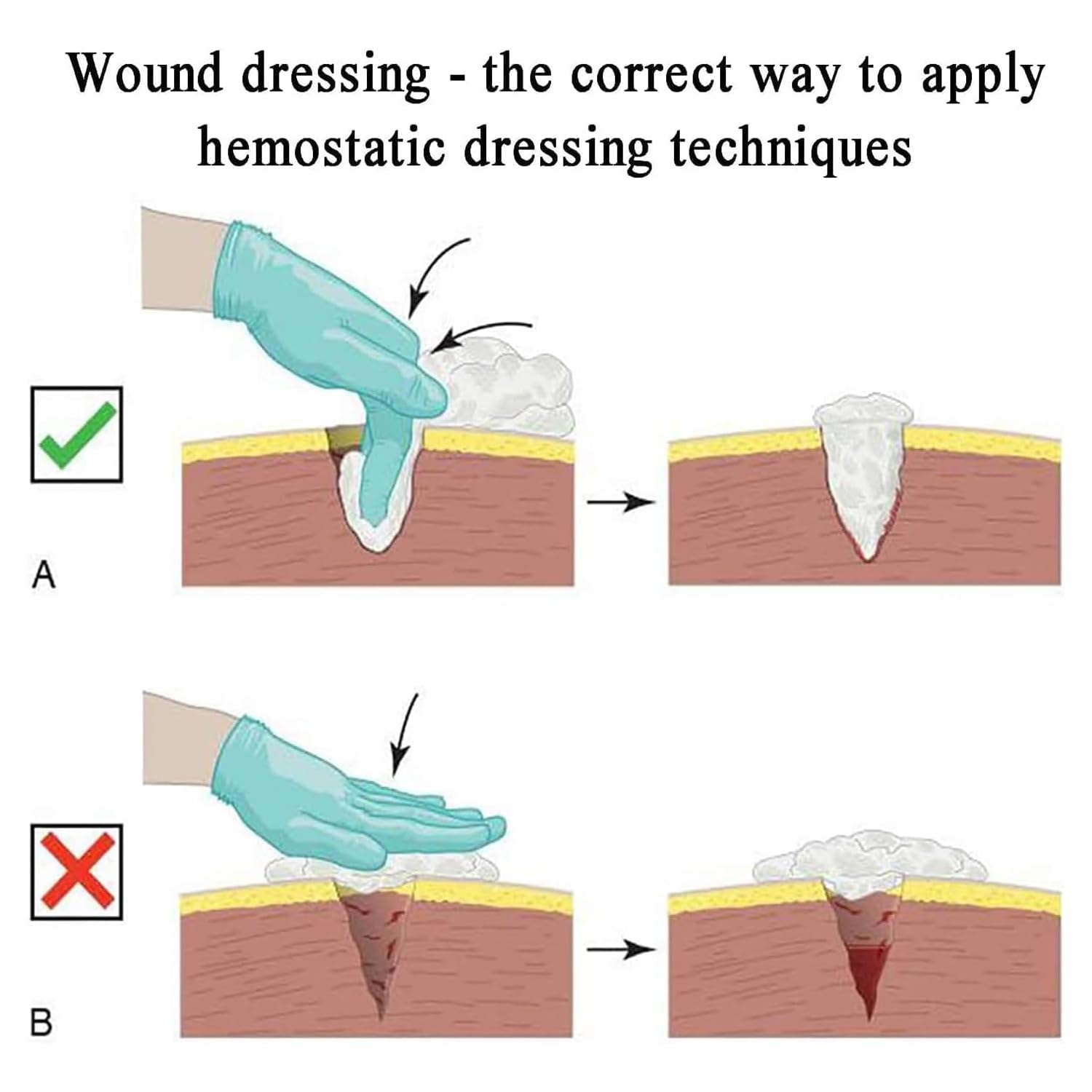 Kit de formación «Stop The Bleed», simulador de taponamiento de heridas en el Muslo, Material de Silicona, Piel simulada hemostática, Reutilizable, para formación en Primeros Auxilios