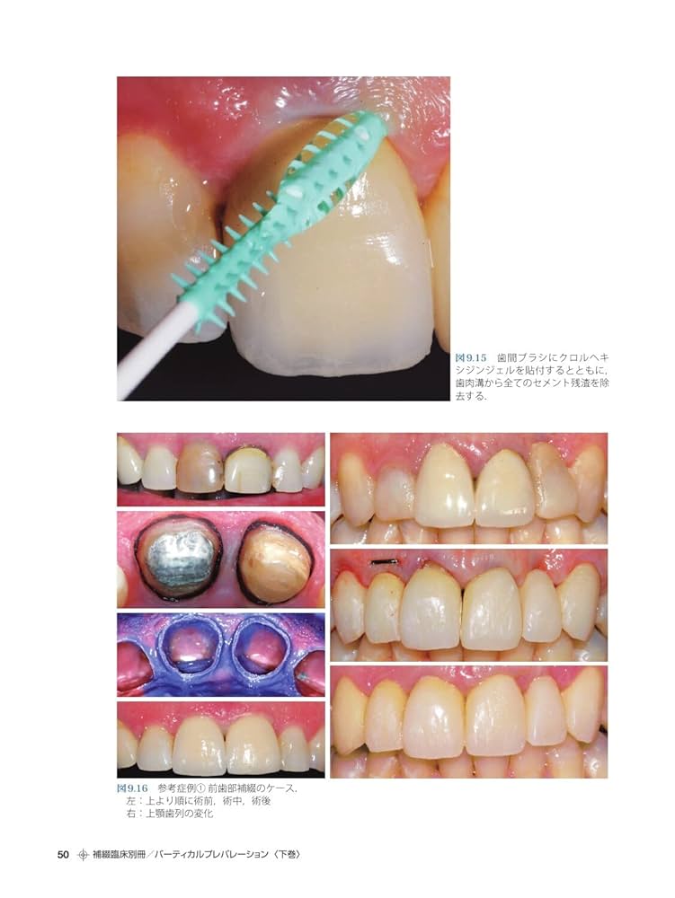 バーティカルプレパレーション 上下巻セット 補綴臨床別冊 バーティカルプレパレーション 下巻 B.O.P.T.