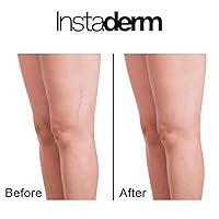 Vista 8 de Crema de vitamina K, fórmula curativa de moretones con árnica. Humectante de manchas oscuras para moretones, arañas vasculares y capilares rotos.