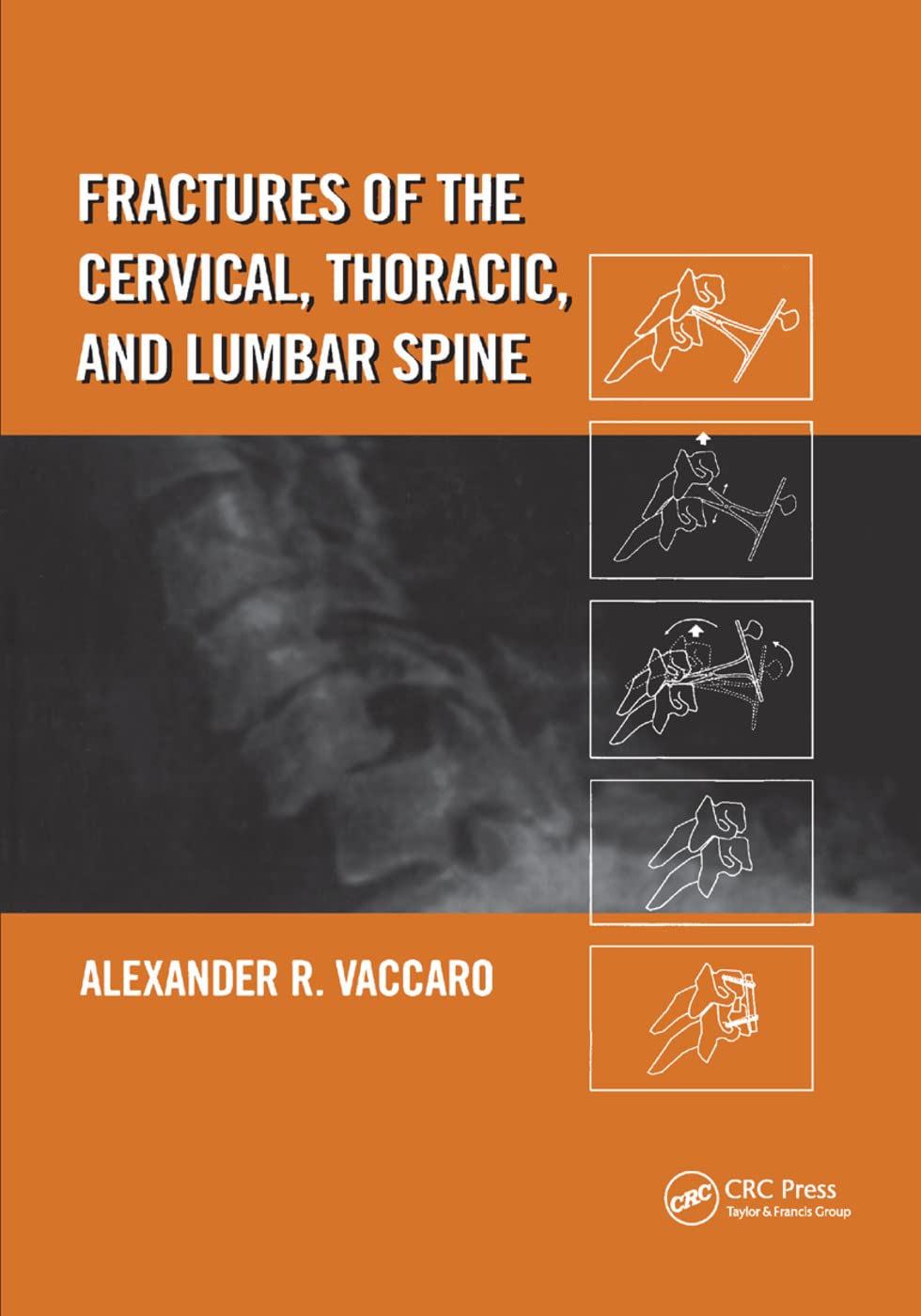 Fractures of the Cervical, Thoracic, and Lumbar Spine