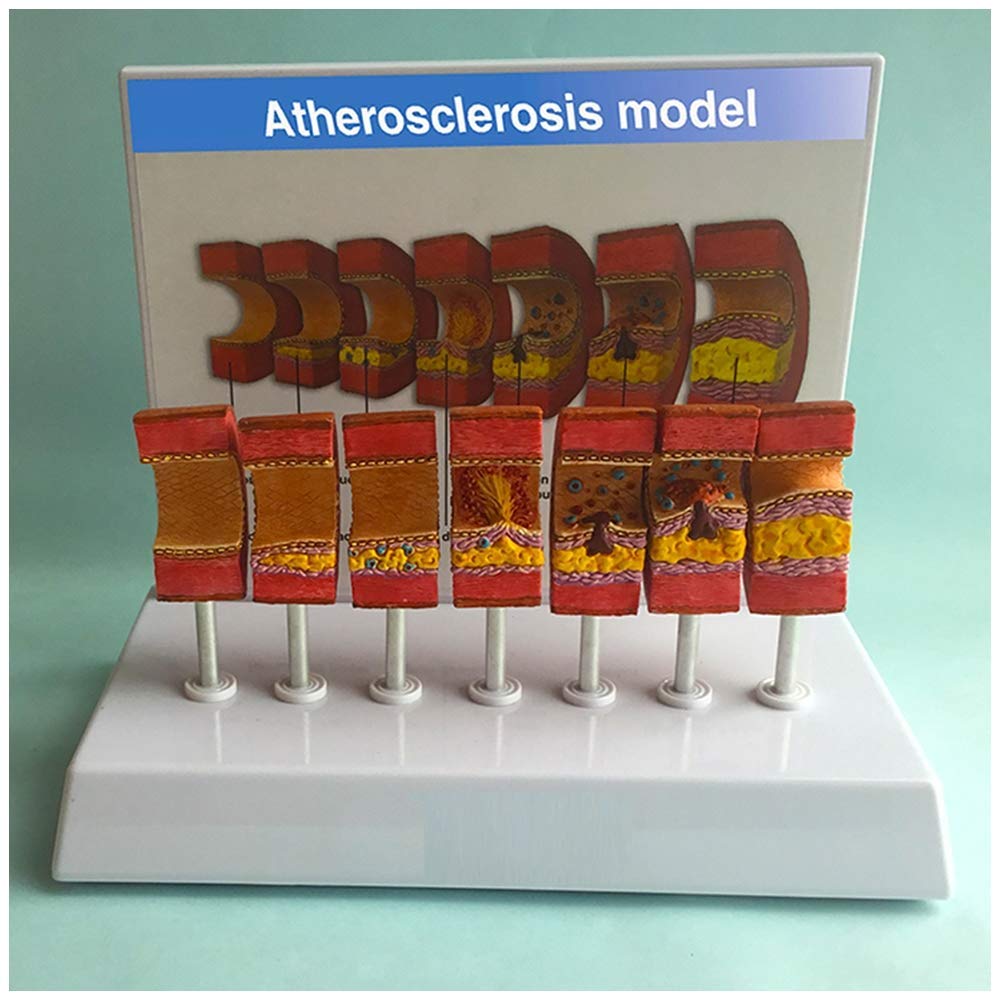 Anatomisches Modell der Arterie - Anatomisches Gefäß-Atherosklerose-Thrombus-Gefäß-Modell Modell der menschlichen Arterie - für das Studien-Display Lehre Medizinisches Modell