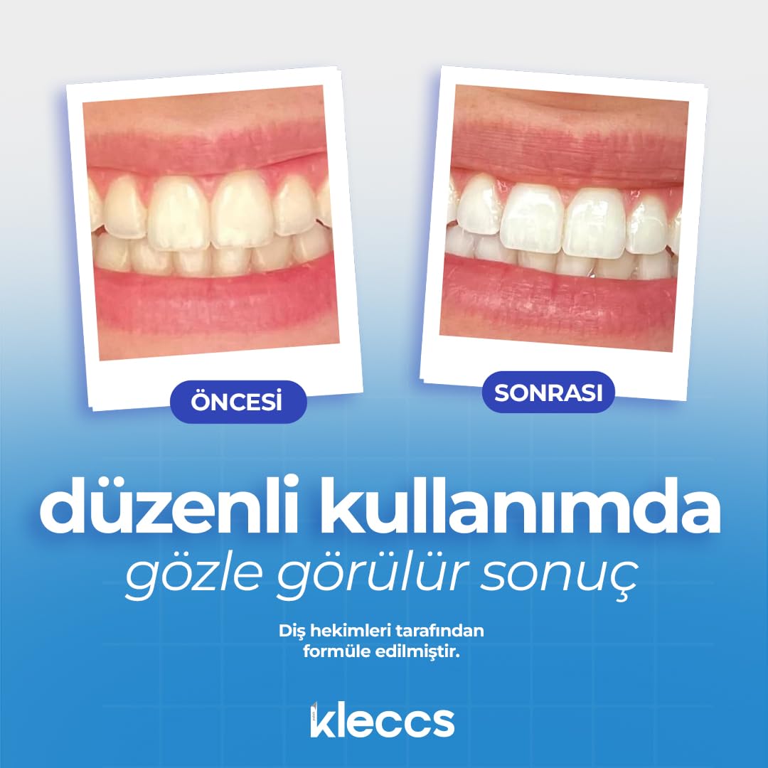 Diş Beyazlatma Bandı, Profesyonel Beyazlık, 14 Paket-28 Bant, Profesyonel Diş Beyazlatma Bandı, Günlük ve Bireysel Kullanıma Uygun